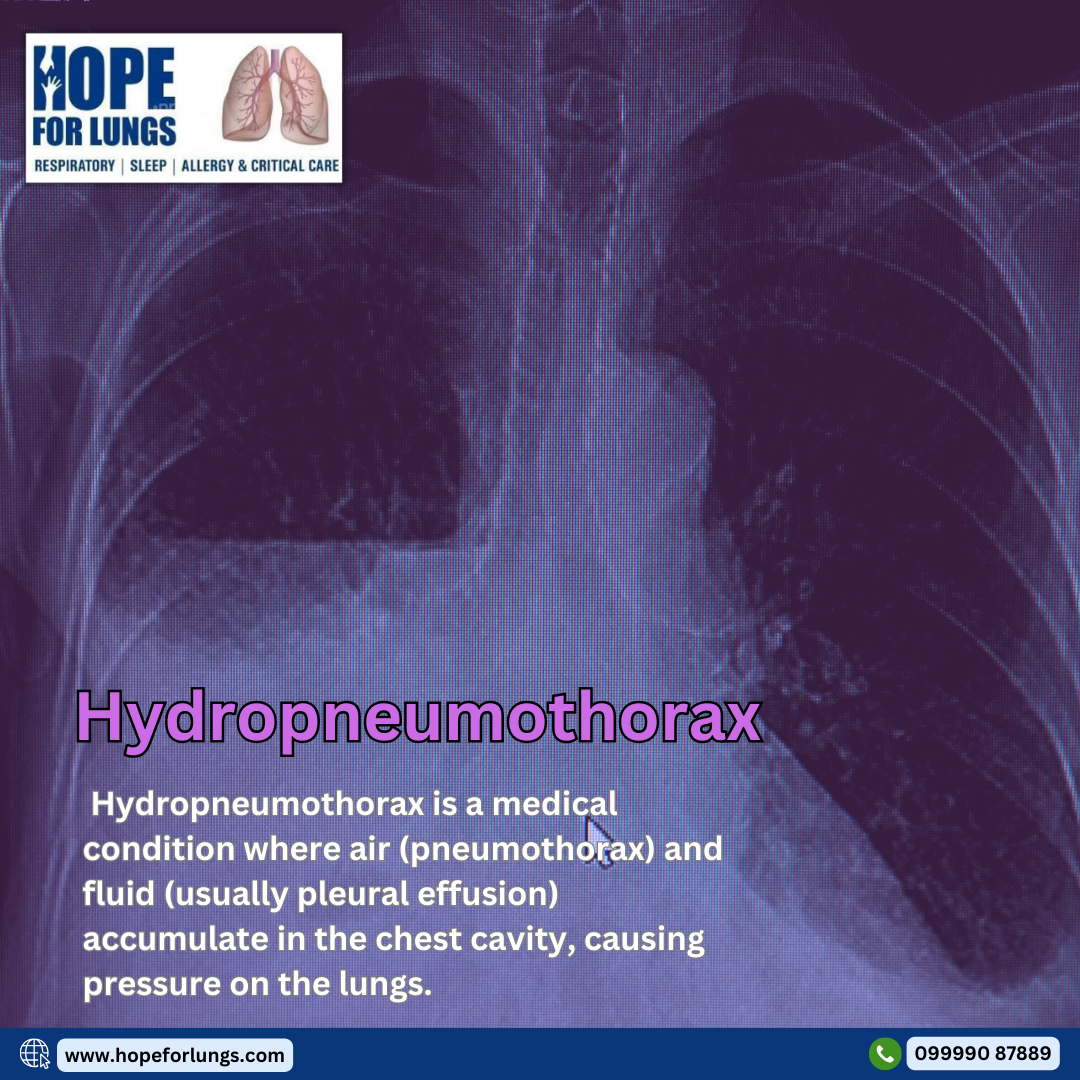 Hydropneumothorax